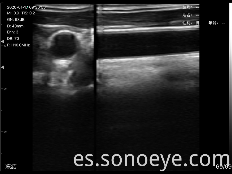 porket ultrasound